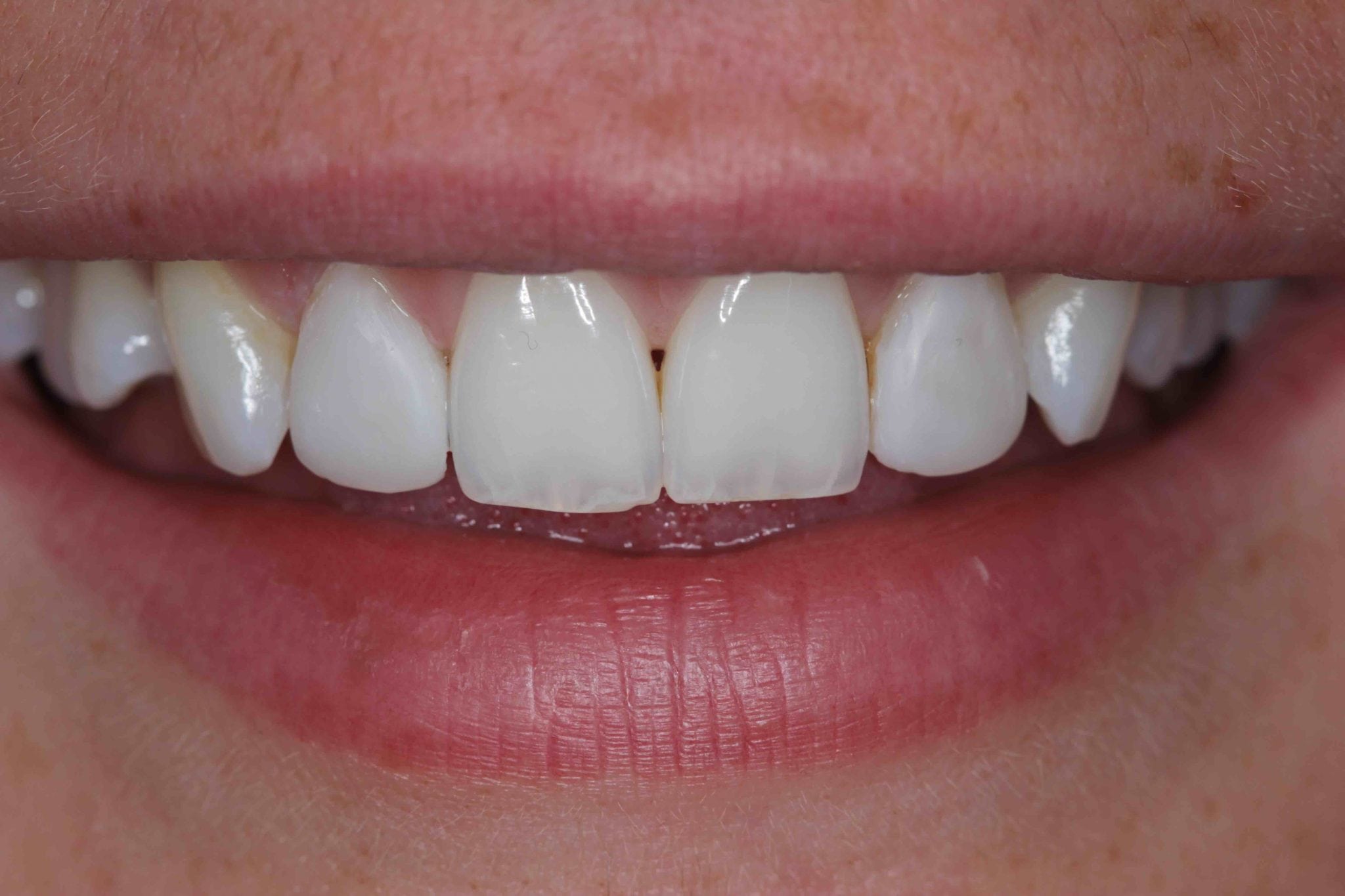 Before And After Composite Bonding: How To Restore Your Teeth To Their Natural State