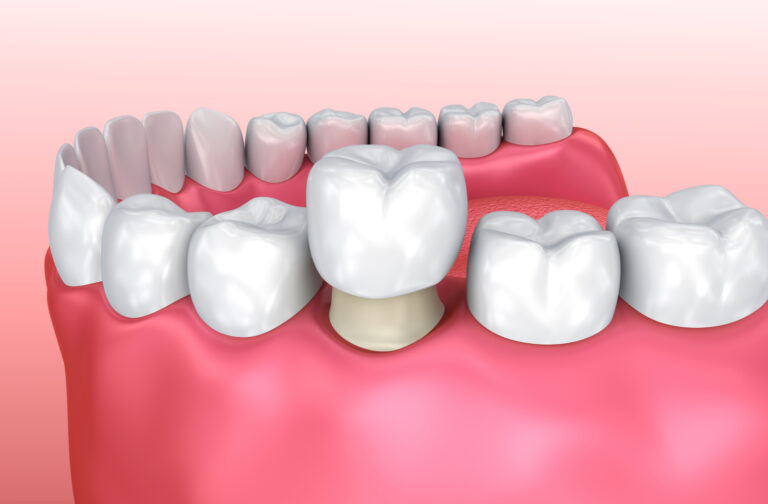 Getting A Crown On Your Front Teeth: The Before And After