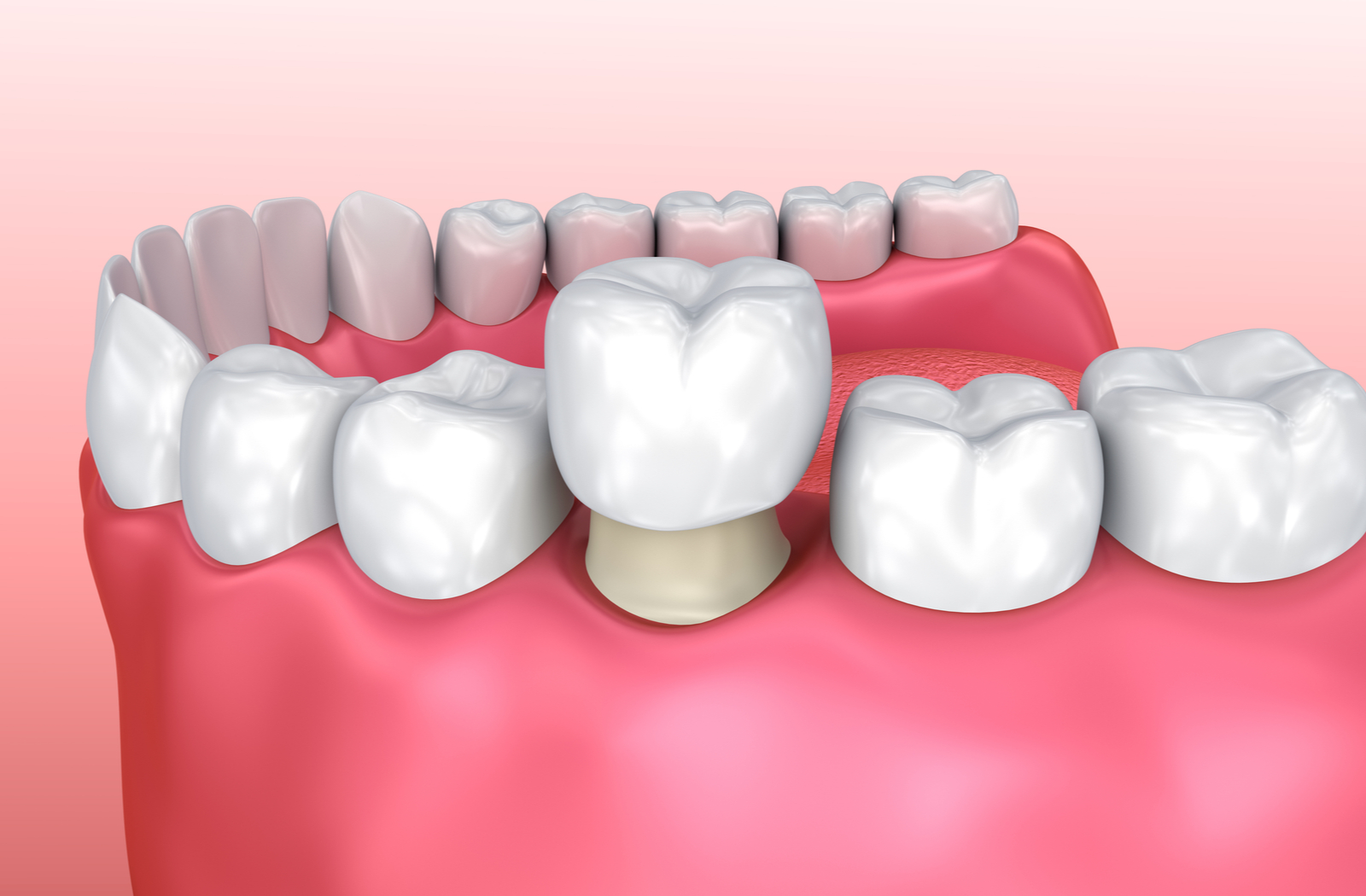 Affordable Dentures Near Me: How To Find The Best Deals