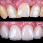 dental veneers near me