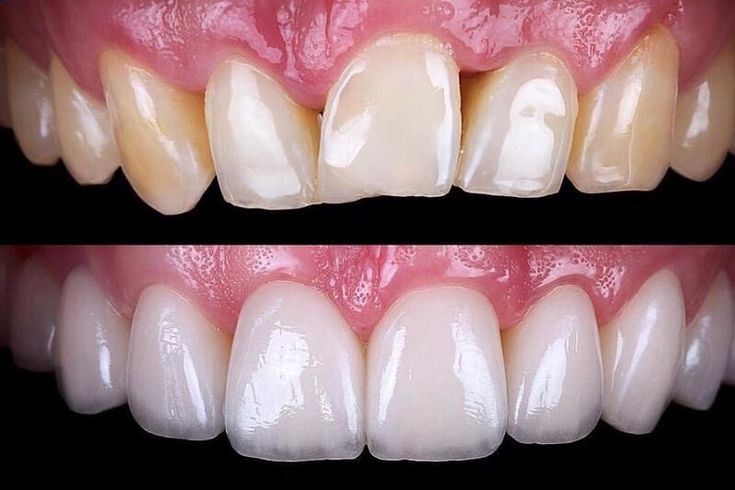 What Are Dental Veneers And Why You Should Consider Them