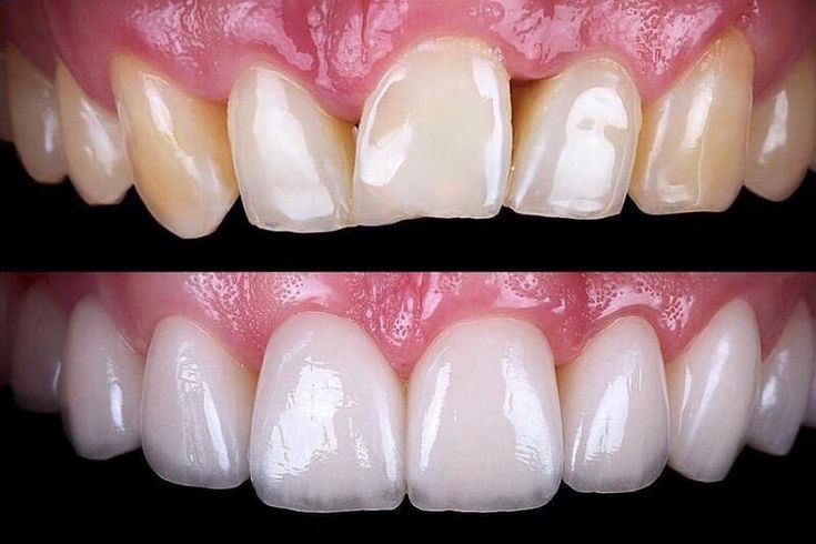 dental veneers near me