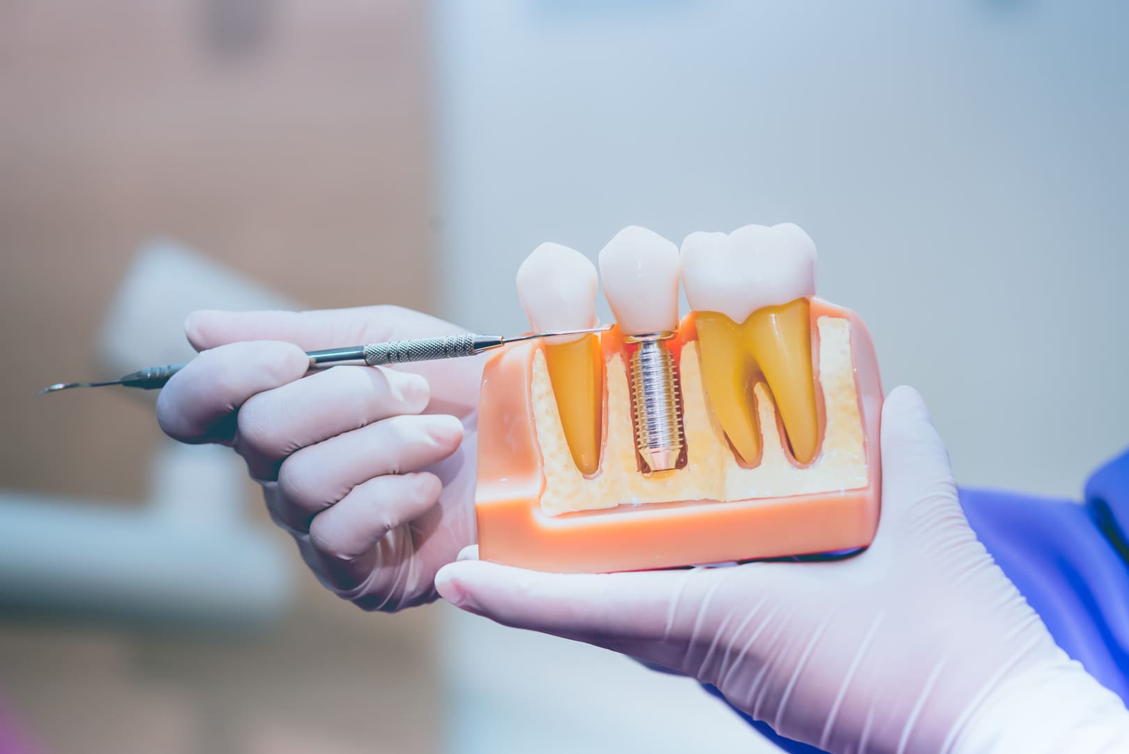Everything You Need To Know About Dentist Implants Near Me