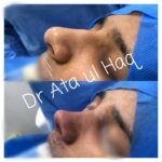 Rhinoplasty cost in Pakistan