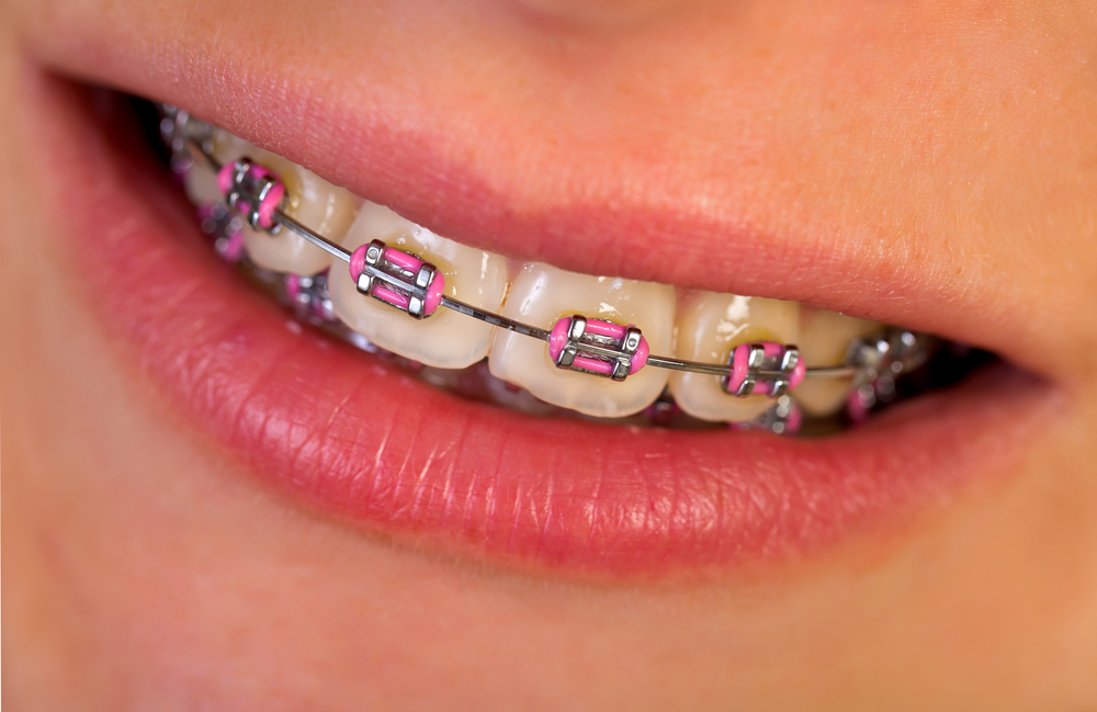 Where To Find The Best Orthodontists Near Me?