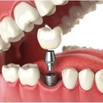 implant dentures dental