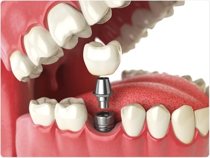 Dental Implant: What You Need to Know About This Lifesaving Procedure